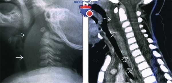 КТ, МРТ при заглоточном абсцессе