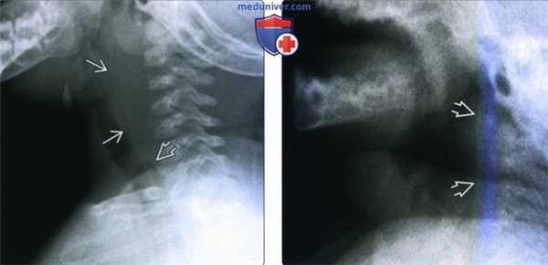 КТ, МРТ при заглоточном абсцессе