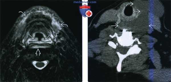 КТ, МРТ при отеке заглоточного пространства