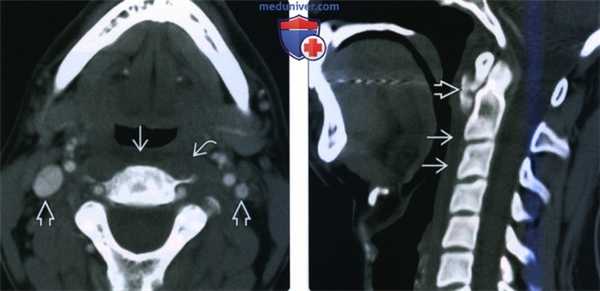 КТ, МРТ при отеке заглоточного пространства