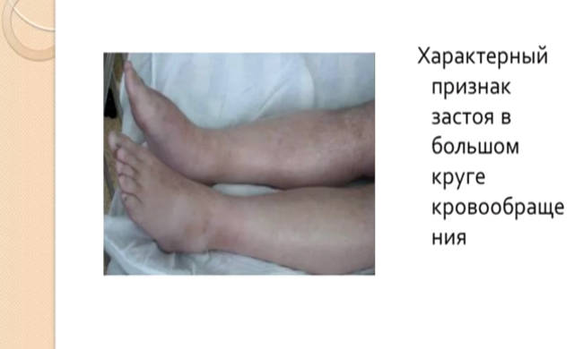 Отеки ног при недостаточности сердца