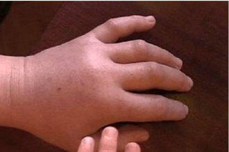 Симптом отека при сердечной недостаточности