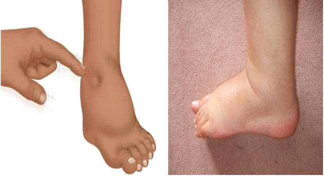 Способ определения отечности