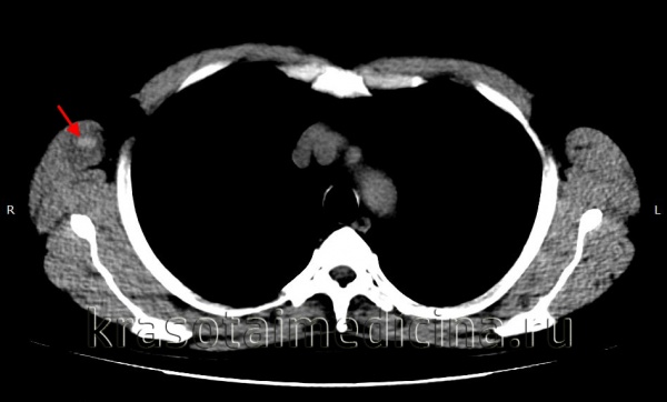 Внутримозговая гематома