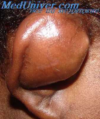 отгематома