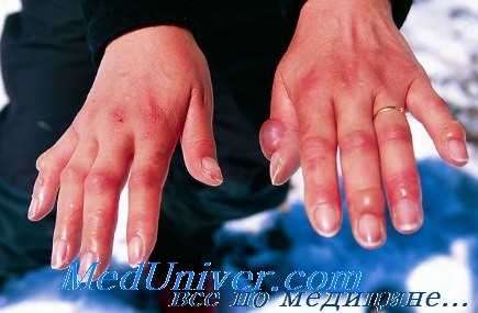 отморожение