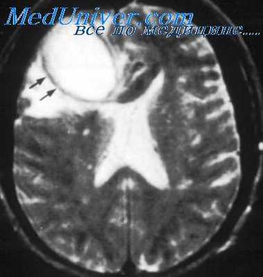 отогенный лептоменингит