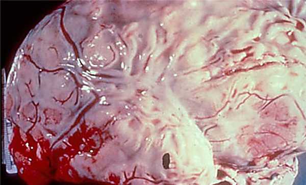 ОТОГЕННЫЙ МЕНИНГИТ .jpg