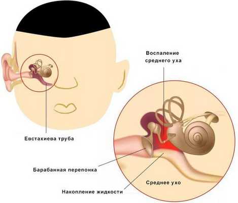 Средний отит