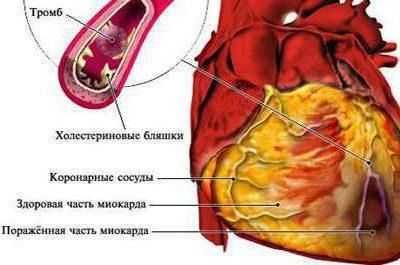 Инфаркт миокарда