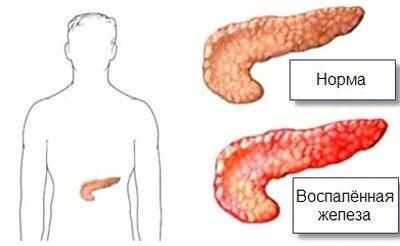 Острый панкреатит