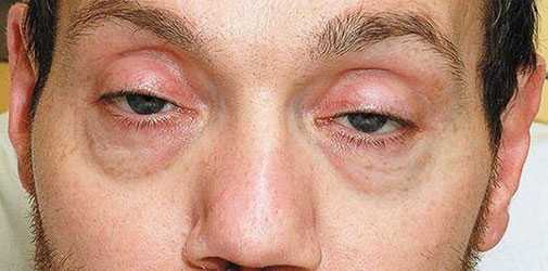 Острая форма отравления опиатами - Алкоклиник