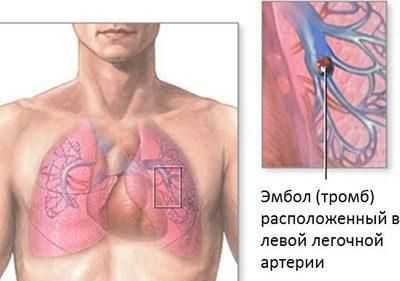 Проявление тромбоэмболии