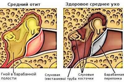 Проявление среднего отита