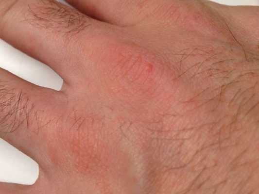 Чесотка без ходов