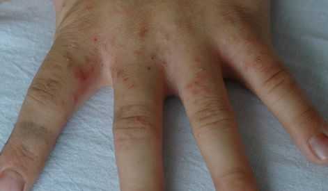 Папулы и везикулы