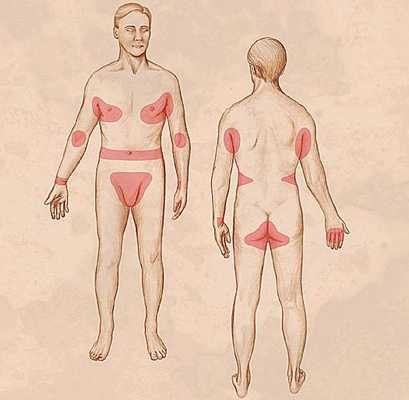 Локализация повреждений кожи при чесотке