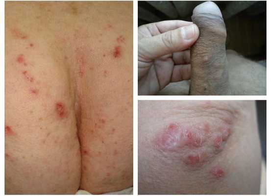 Скабиозная лимфоплазия