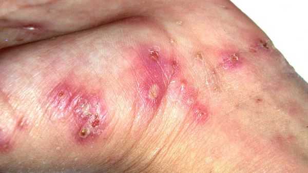 Нагноение расчёсов