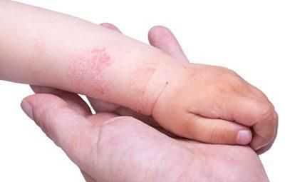 Аллергия на косметические средства