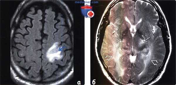 Отравление наркотиками на МРТ головного мозга