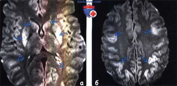 Отравление цианидами на МРТ головного мозга