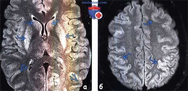 Отравление цианидами на МРТ головного мозга