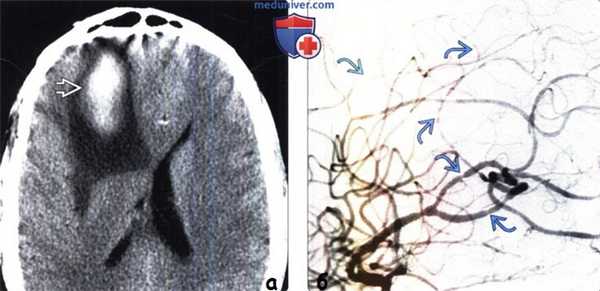 Отравление наркотиками на КТ, ангиограмме головного мозга