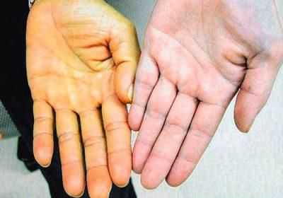 Желтизна кожи