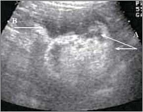 Ультрасонограмма правой почки