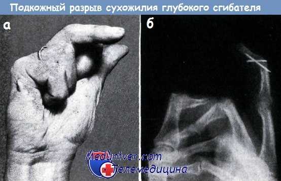 Подкожный разрыв сухожилия глубокого сгибателя