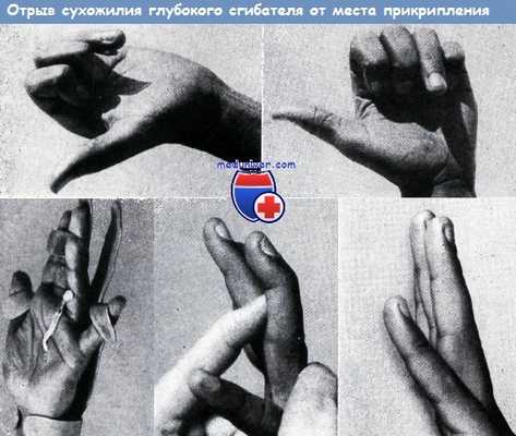 Отрыв сухожилия глубокого сгибателя от места прикрепления