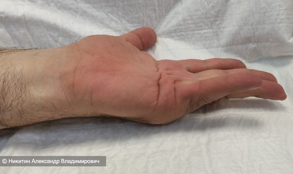 I степень контрактуры Дюпюитрена