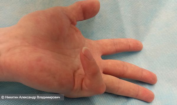 III степень контрактуры Дюпюитрена