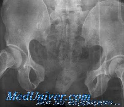 переломы костей таза