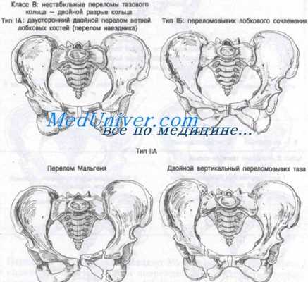 перелом костей таза