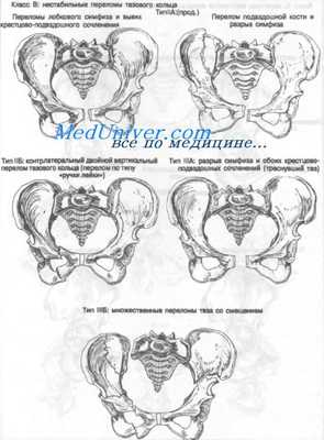перелом костей таза