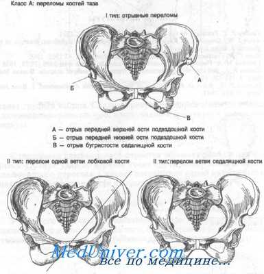 перелом костей таза