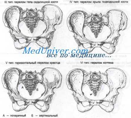 перелом костей таза