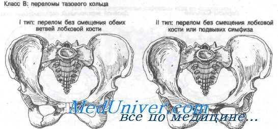 перелом костей таза