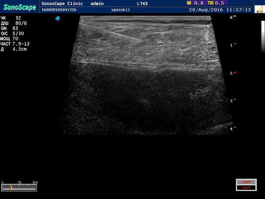 Игольчатый электрод в мышце при УЗ-исследовании