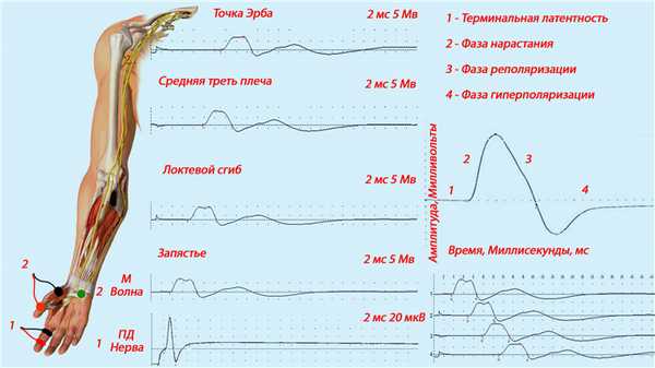 Стимуляционная ЭМГ