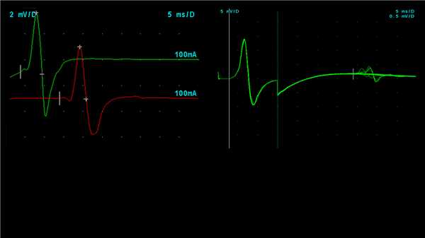 Стимуляционная ЭМГ большеберцового нерва + F-волна