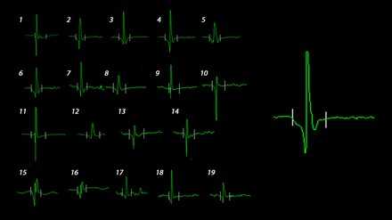 Схема произвольно набранных 20 потенциалов двигательных единиц в стандартной точке мышцы