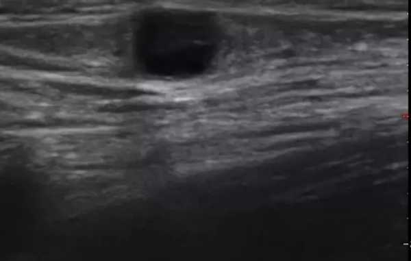 Паховые лимфоузлы на УЗИ