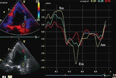 Тканевая допплерография при постинфарктном кардиосклерозе. У больного с постинфарктным кардиосклерозом регистрируется высокоамплитудный пик постсистолической скорости (Sps)