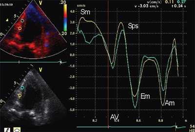 Тканевая допплерография в норме. У больного с постинфарктным кардиосклерозом регистрируется высокоамплитудный пик постсистолической скорости (Sps)