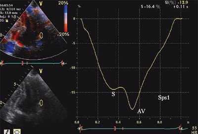 Кривые деформации миокарда в норме