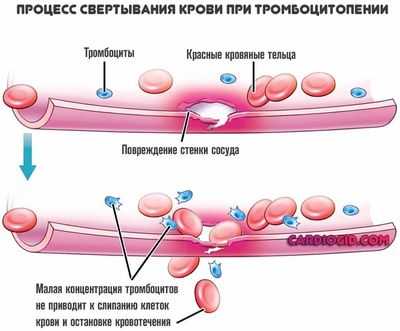 тромбоцитопения