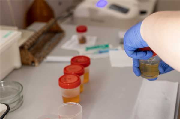 Анализ на креатинин. Норма, отклонения от нормы, их причины